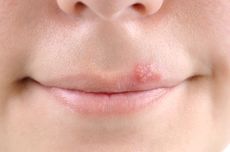Kenali Penyakit Herpes di Bibir: Penyebab, Gejala, dan Cara Pengobatan