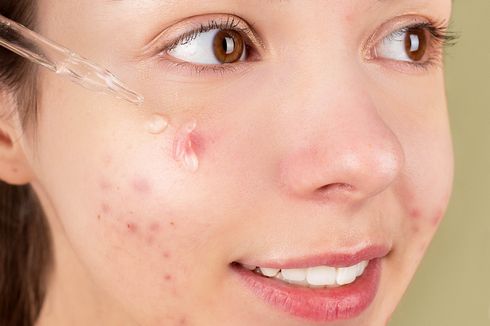 Jangan Pakai Skincare, Jerawat Harus Diatasi Secara Medis