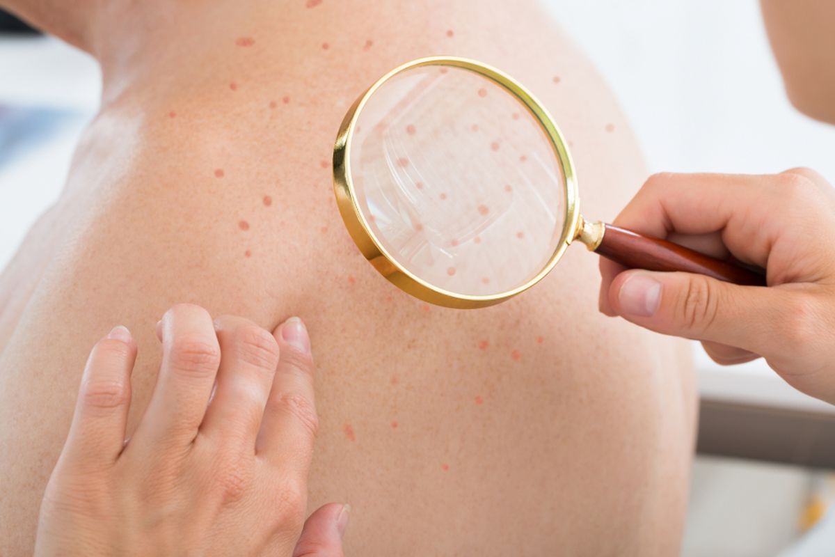 Close-up Of A Doctor Checking Skin Of Senior Male Patient With Magnifying Glass