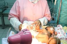 Bayi Kembar Dempet Dirujuk ke RS Surabaya