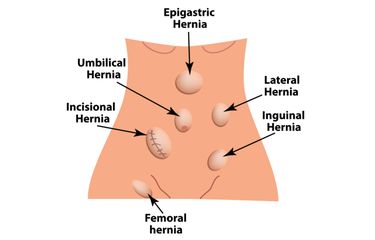 Ilustrasi Hernia