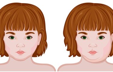 Ilustrasi gondongan atau parotitis. Ciri-ciri gondongan pada anak dan orang dewasa.