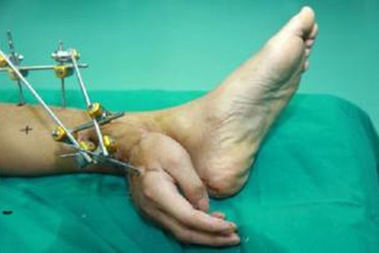Setelah mengalami kecelakaan parah, tangan kanan Wei dijahit di pergelangan kakinya.