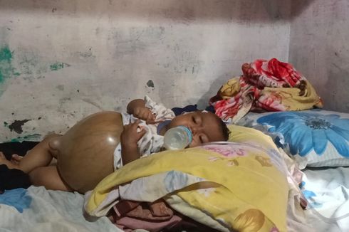 Derita Bayi Aiyla Idap Atresia Bilier, Perut Membesar dan Sulit Bernapas, Butuh Bantuan Dermawan