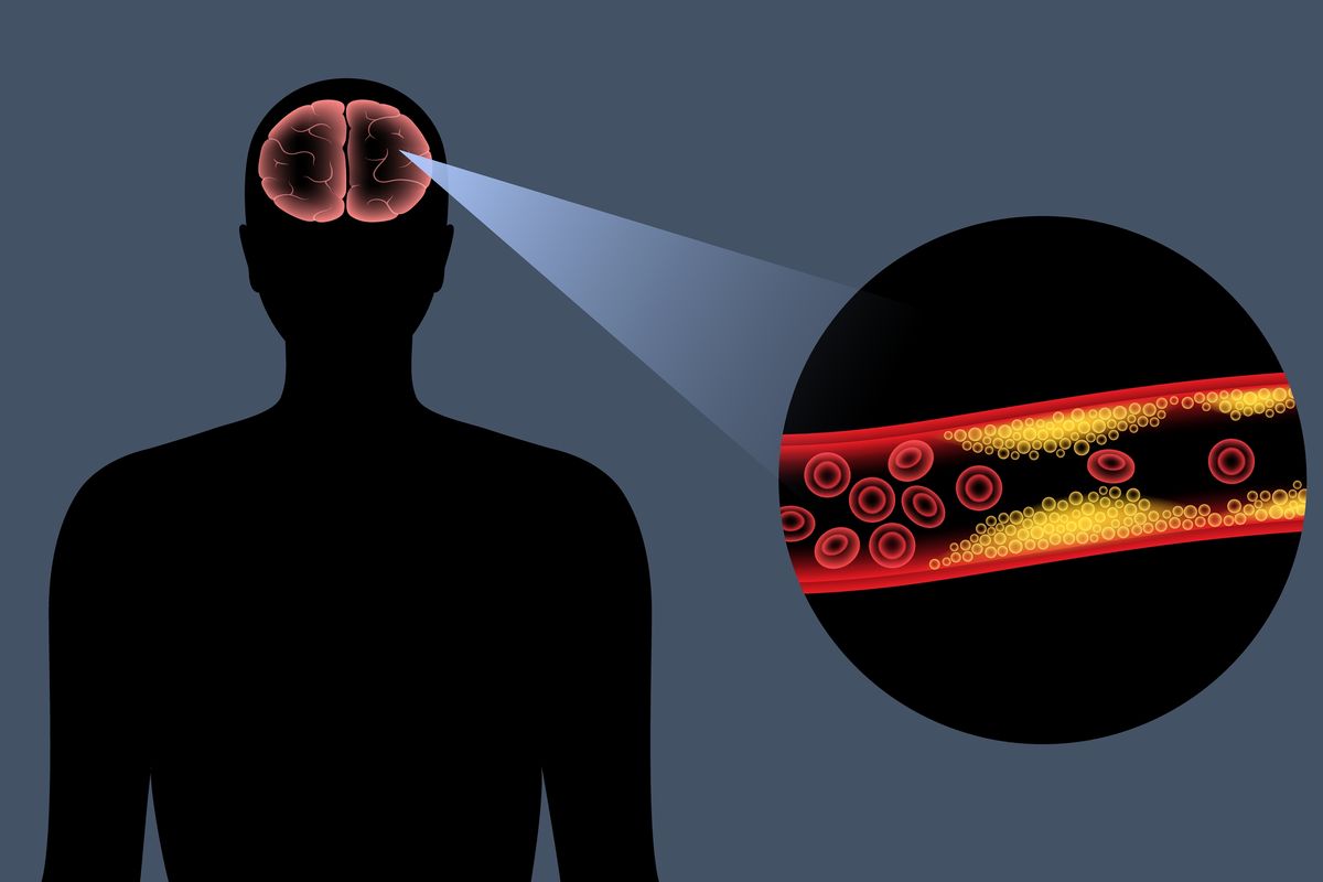 Ilustrasi stroke ringan, stroke ringan apakah bisa sembuh total.