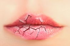 7 Cara Mengatasi Bibir Kering Secara Alami