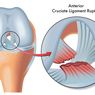 Cedera Ligamen Lutut Anterior 