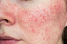 Apakah Rosacea Menular? Simak Penjelasan Berikut…