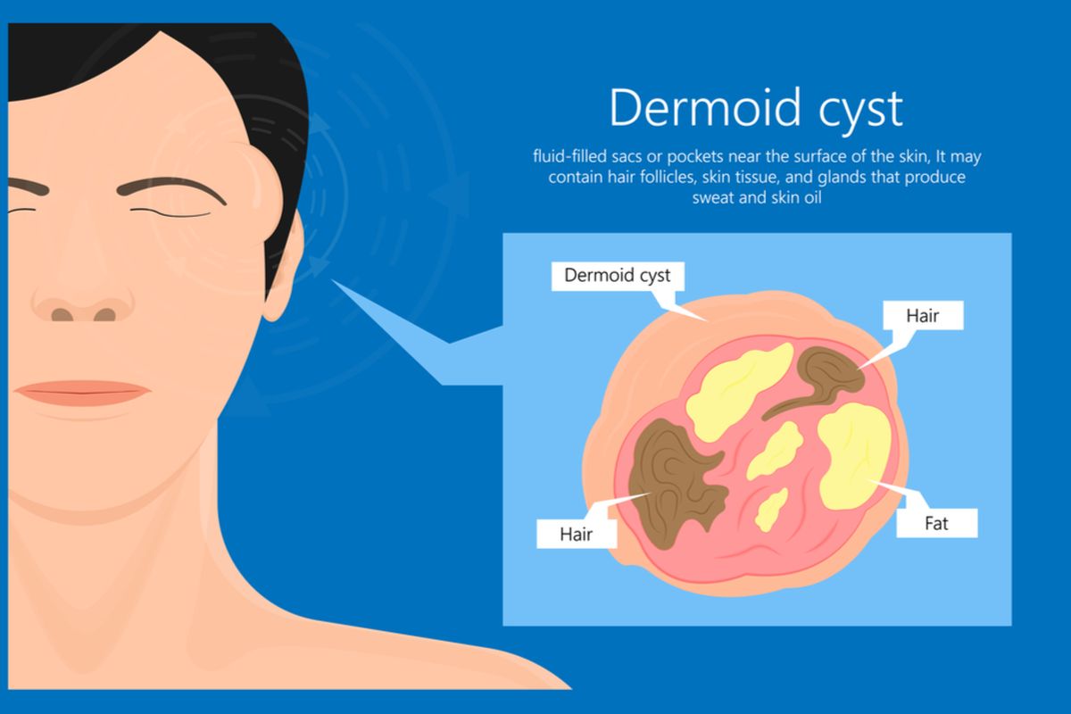 Ilustrasi kista dermoid