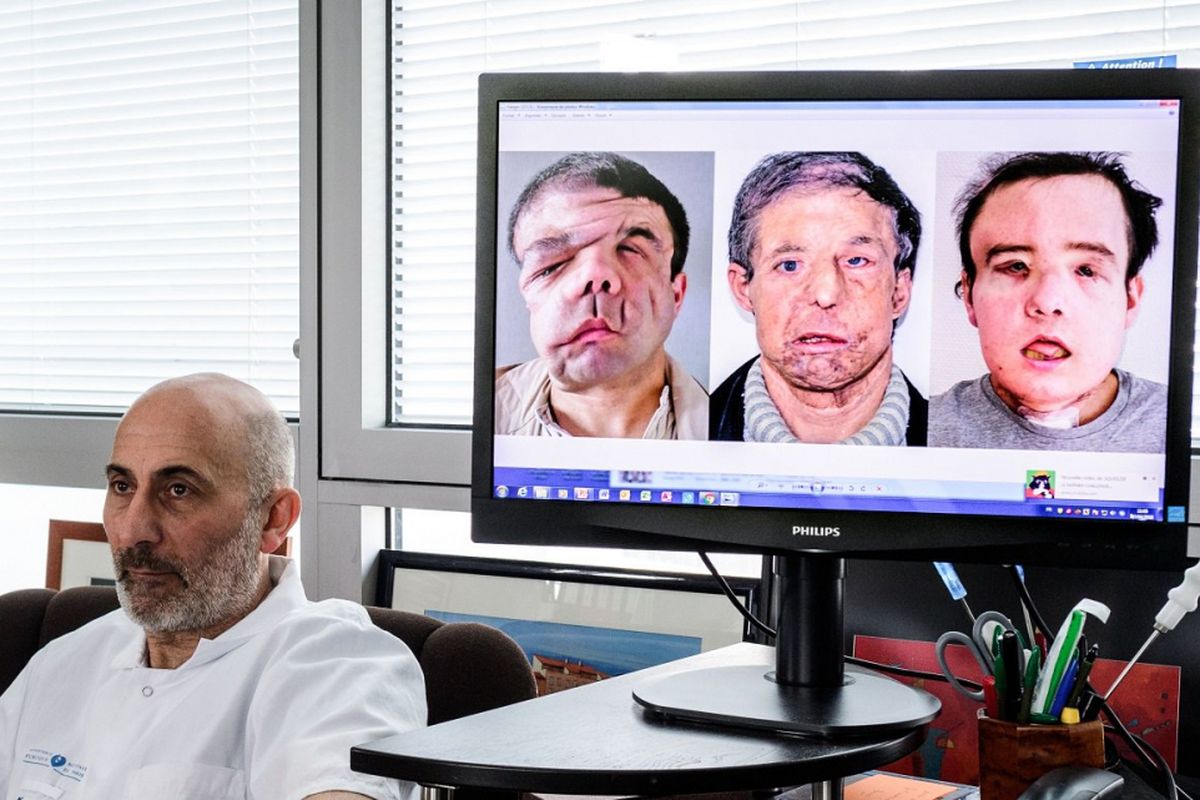 Profesor kedokteran Perancis Laurent Lantieri, spesialis dalam transplantasi tangan dan wajah, berpose di samping layar yang menunjukkan tiga wajah berbeda dari operasi pasien Jerome Hamon.