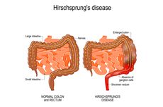 Penyakit Hirschsprung