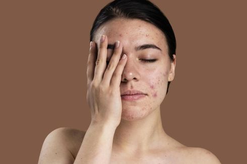 Adult Acne Bisa Jadi Tanda Adanya Masalah Kesehatan 