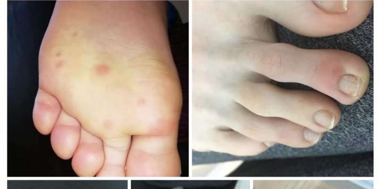 Banyak pasien Covid-19 mengaku memiliki lesi keunguan di sekitar jari kaki sebelum gejala virus corona pada umumnya muncul.