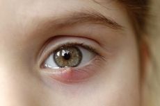 Mata Bintitan: Penyebab, Pencegahan, dan Cara Mengatasinya