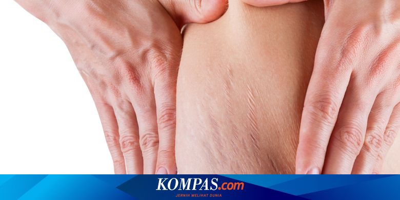 Selulit Atau Stretch Mark Mana Yang Lebih Sulit Dihilangkan Halaman All Kompas Com