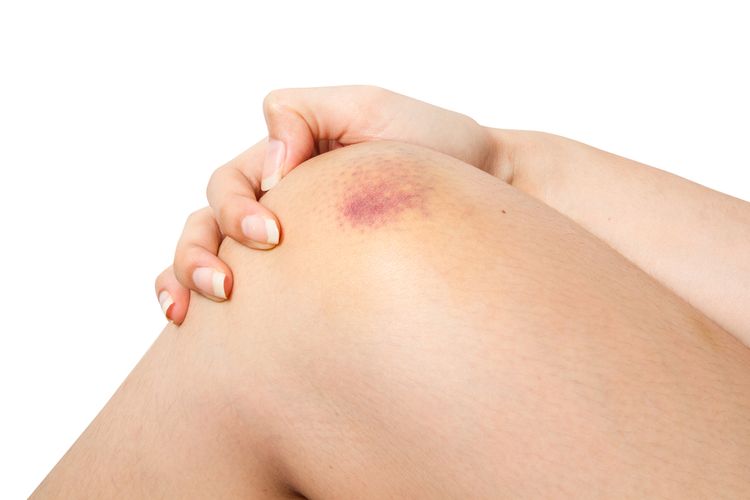 Memar biru pada kulit tanpa rasa sakit disebut purpura simplex
