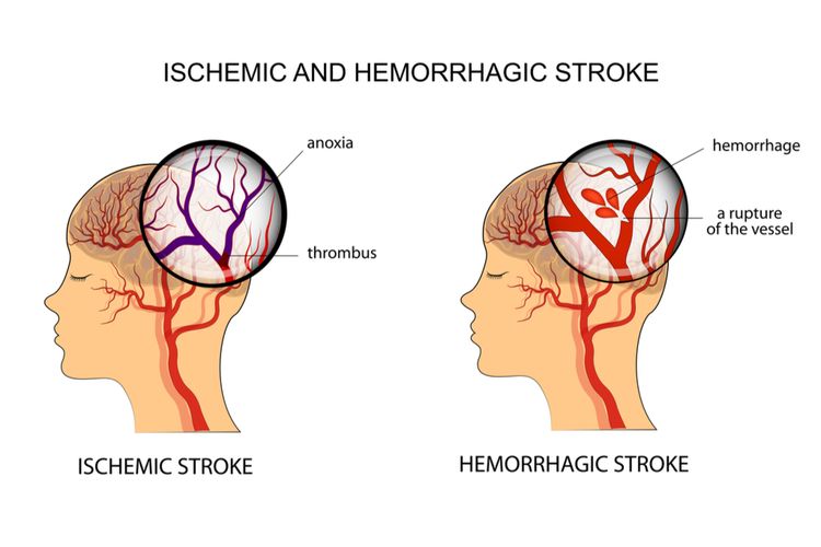 ilustrasi stroke iskemik dan stroke hemoragik