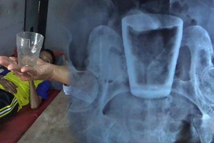 Kolase foto penampakan gelas dalam perut Lasiadi dan hasil rontgen RSD Balung, Jember. Gelas dalam perut Lasiadi berhasil dikeluarkan pada 29 Maret 2022.