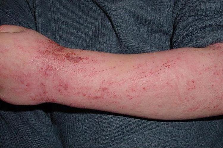 Ilustrasi Atopic Dermatitis atau Eksim.