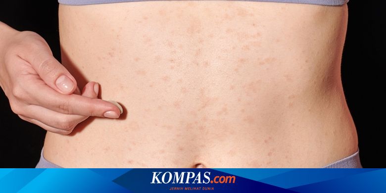 Berita Harian Perbedaan-bintik-merah-dbd-dan-biang-keringat Terbaru ...