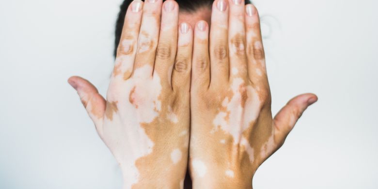 Vitiligo dapat terjadi di sejumlah area tubuh, bahkan rambut.