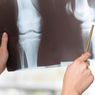 Pakar Unair: Waspada, Malas Gerak Berisiko Alami Osteoporosis