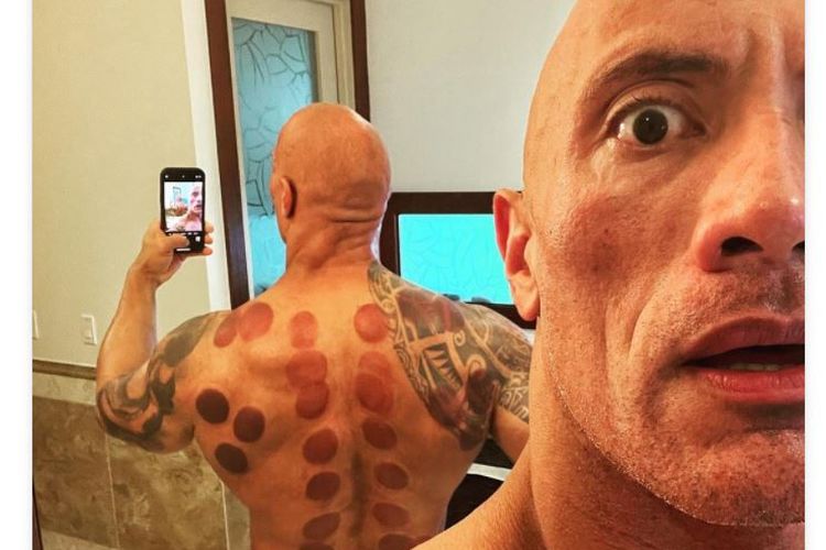 Unggahan The Rock di Instagram yang menunjukkan dirinya mencoba terapi bekam atau cupping