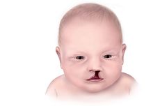 Anak dengan Kelainan Celah Bibir dan Langit-langit Mulut Berisiko Alami Ganggu Perkembangan