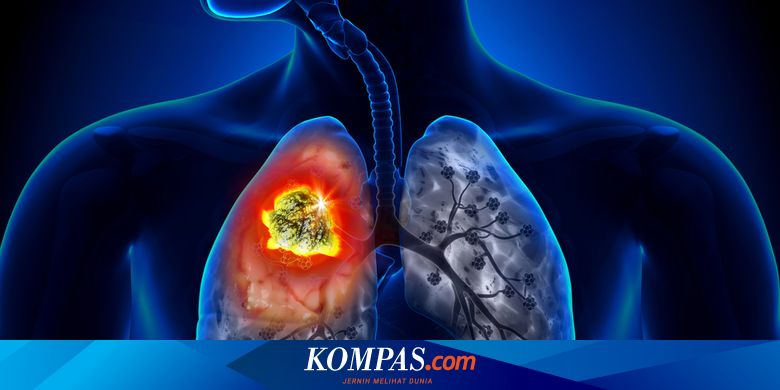 Mengenal Beberapa Pengobatan Kanker Paru Nomor 4 Paling Baru