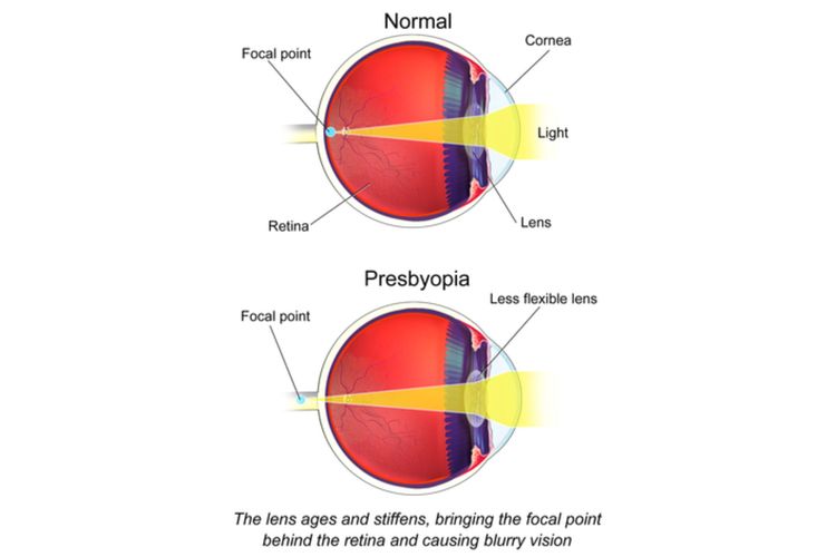 Ilustrasi presbiopi atau mata tua