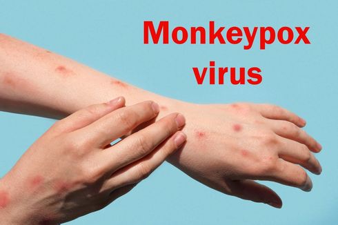 Pakar Unair: Ini Tanda Utama Virus Cacar Monyet