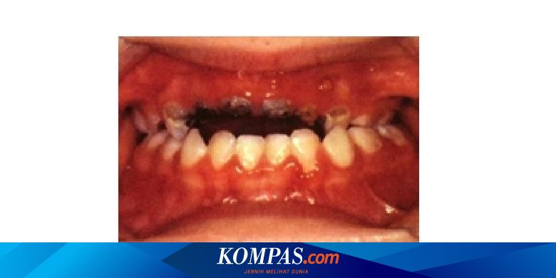 Gigi Atas Anak Tinggal Sedikit Akibat Karies Bolehkah Dicabut