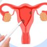 7 Faktor Risiko Kanker Endometrium yang Perlu Anda Ketahui