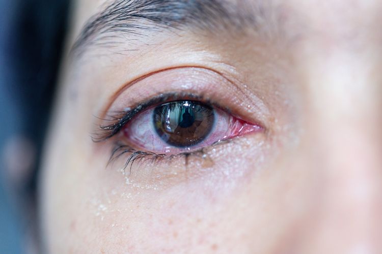 Iritasi oleh disebabkan penyakit mata penyakit iritasi