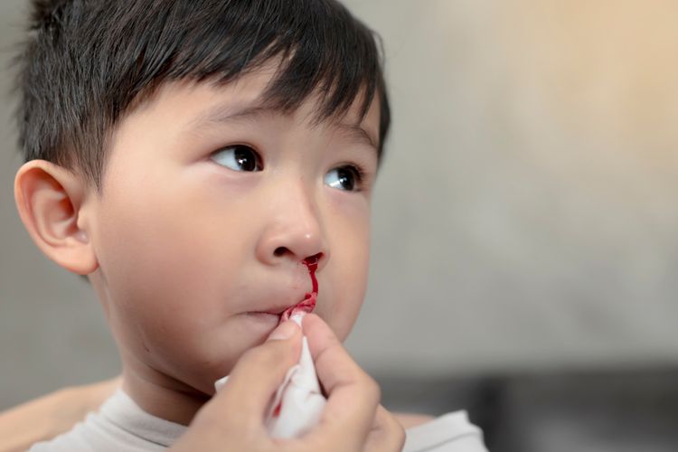 Mimisan bisa menjadi tanda hemofilia pada anak. 