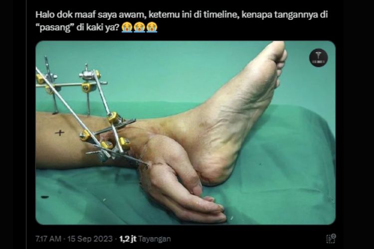 Tangkapan layar foto tangan disambung ke kaki ketika operasi.
