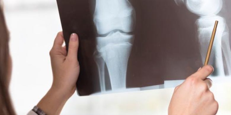 Cara Mencegah Osteoporosis Pada Usia Muda Halaman All Kompas Com