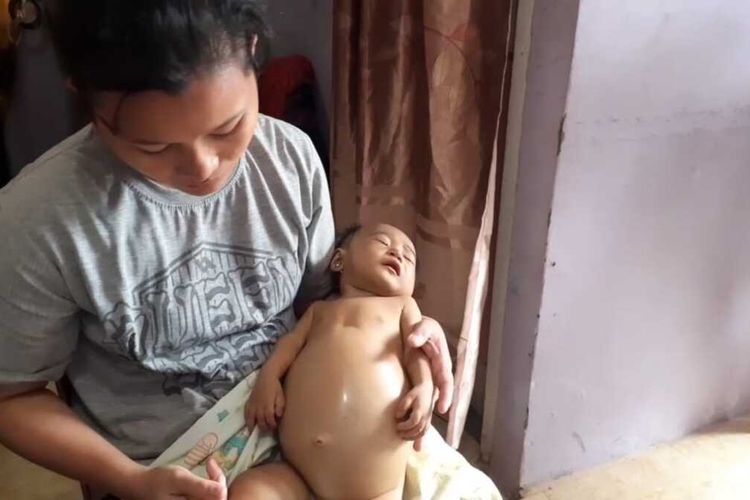 Dengan posisi ditimang sang Ibunya, Nadine Sohaga Gulo bayi berusia 6 bulan, dengan perut membengkak hanya terkulai lemas dan meringis kesakitan menahan penyakit langka yang dideritanya dengan diagnosa  Atresia Bilier yakni bayi penderita kelainan fungsi hati, sudah 2 RSU tak mampu merawatnya dan berencana akan dibawa RSCM Jakarta dan berharapada dermawan yang mampu membantu pembiayaan pengobatan putrinya.