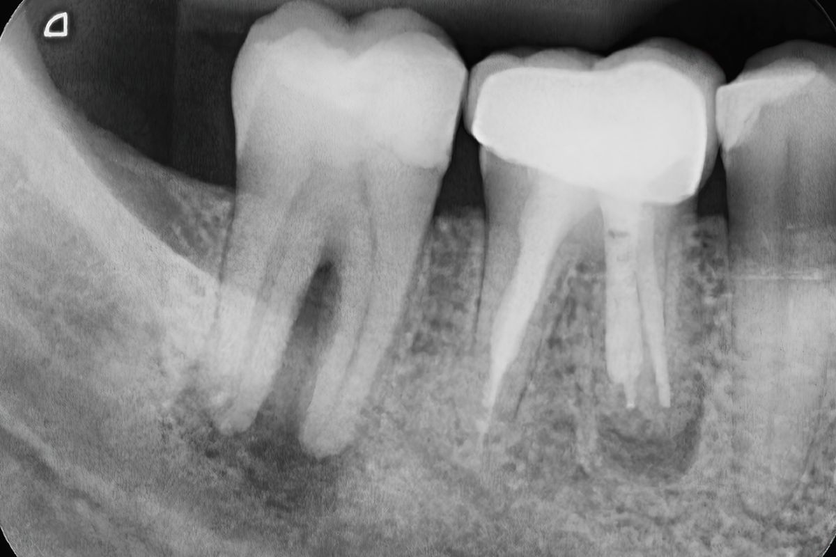 Ilustrasi abses gigi akibat sisa akar gigi