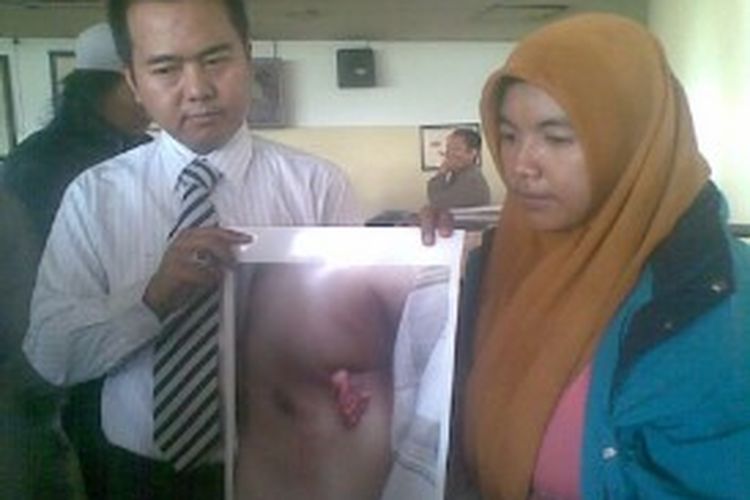 Ifa Hadyah (kanan), kakak korban dugaan malapraktik Afrizal Fahri, menunjukkan foto bekas luka operasi, dengan didampingi pengacara.