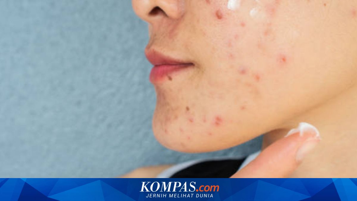 Ketahui, Beda Ciri Jerawat Stres dan Hormonal