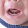 Tongue Tie