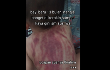Ramai soal Punggung Bayi Memerah Usai Dikerok, Bolehkah Anak ...