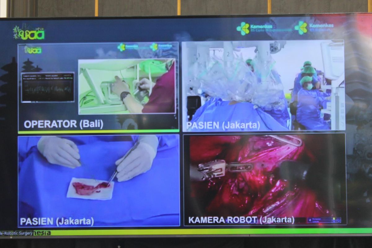 Operasi jarak jauh menggunakan robot (telerobotik) sukses dilakukan oleh dokter di Bali kepada pasien yang berada di Jakarta, Jumat (30/8/2024). 