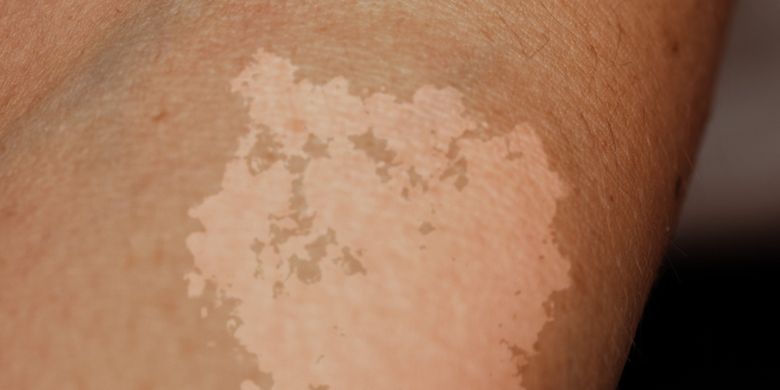 Gambar lengan orang yang menderita panu, infeksi jamur malassezia globosa, yang menyebabkan bercak perubahan warna kulit.

