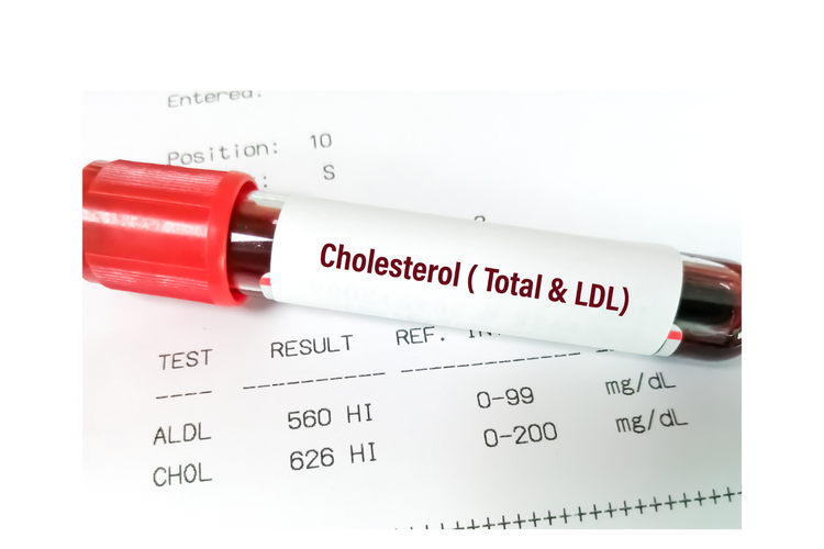 Kombinasi Obat Lama dan Baru Turunkan Kolesterol Jahat Hampir 50%