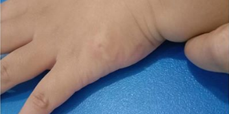 Ada Cacing Hidup Di Bawah Kulit Anak Anji Kok Bisa Halaman All Kompas Com