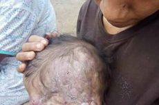 Disangka Gigitan Nyamuk, Ternyata Bayi Ini Terkena Tumor di Wajah, Begini Kondisinya  