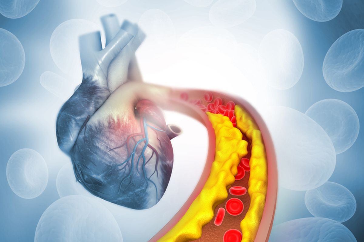 Ilustrasi aterosklerosis. Aterosklerosis dapat menyebabkan Anda mengalami serangan jantung dan stroke. Ini bisa disebabkan oleh hipertensi dan kolesterol tinggi.