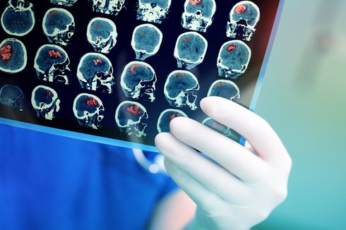 Apa Penyebab Terjadinya Tumor Otak?